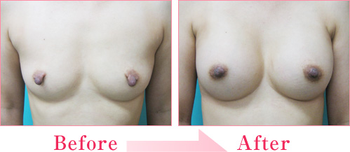 豊胸（人工乳腺法）+乳頭縮小術